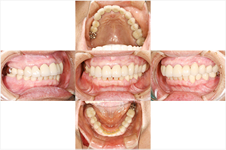 インプラント治療後一例：口腔内撮影