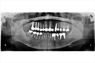 インプラント治療後一例：レントゲン撮影